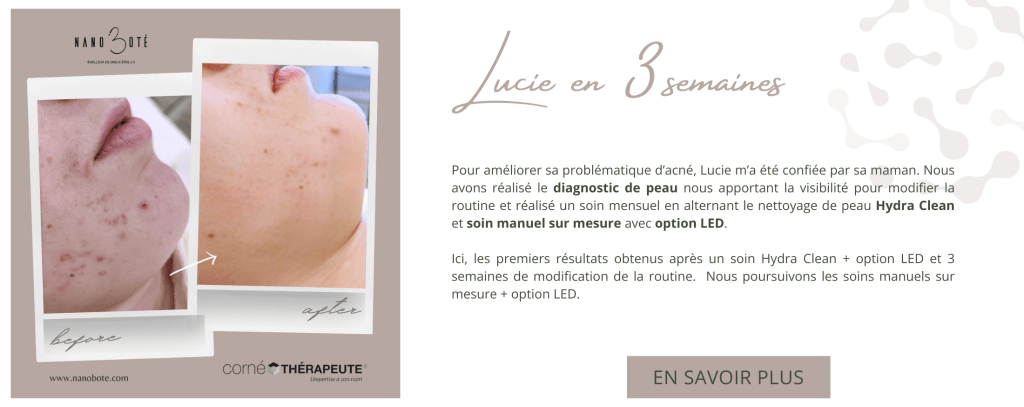 acné boutons soins visage nano boté clermont ferrand