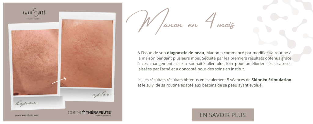 tâches pigmentaires, masque de grosses, tâche visage nano boté clermont ferrand