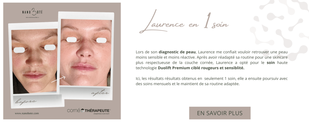 rougeurs, peau sensible, couperose soins visage nano boté clermont ferrand