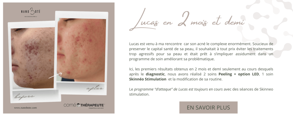 acné boutons soins visage nano boté clermont ferrand 2