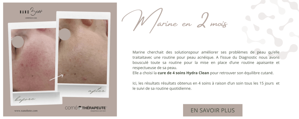 rougeurs, peau sensible, couperose soins visage nano boté clermont ferrand 2