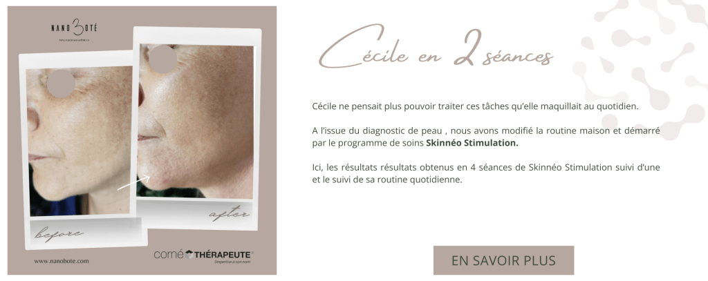 tâches pigmentaires, masque de grosses, tâche visage nano boté clermont ferrand 3