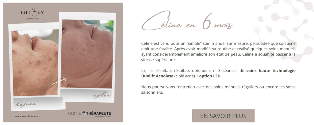 acné boutons soins visage nano boté clermont ferrand 4