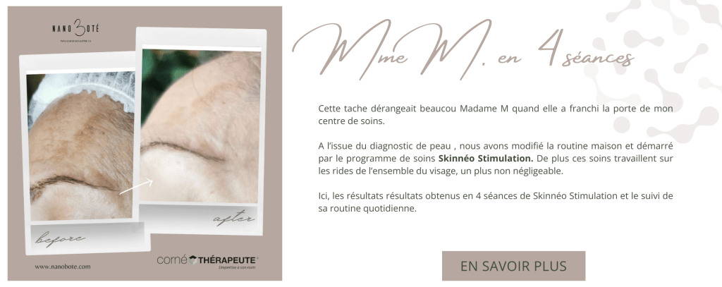 tâches pigmentaires, masque de grosses, tâche visage nano boté clermont ferrand 4