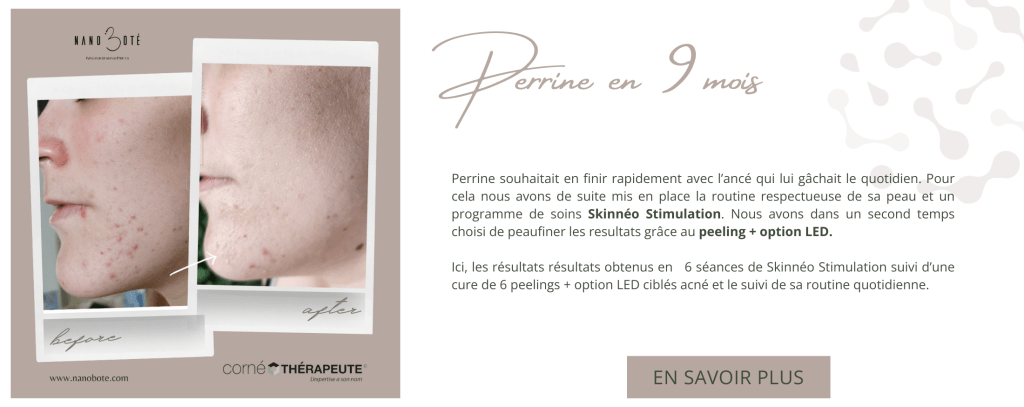 acné boutons soins visage nano boté clermont ferrand 5