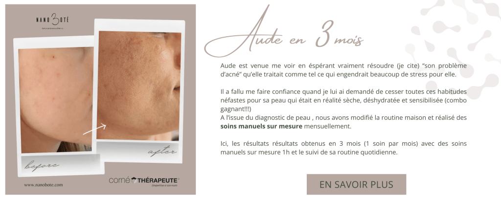 rougeurs, peau sensible, couperose soins visage nano boté clermont ferrand 5