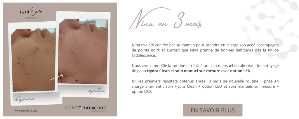 acné boutons soins visage nano boté clermont ferrand 6