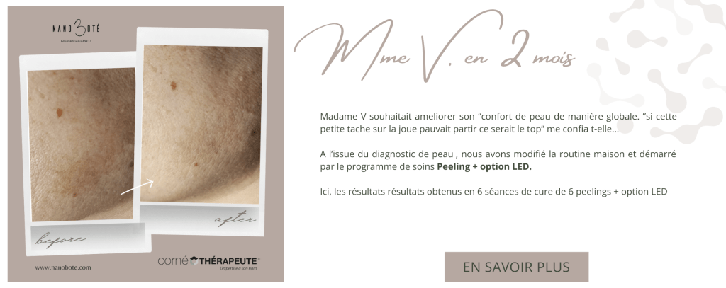 tâches pigmentaires, masque de grosses, tâche visage nano boté clermont ferrand 5