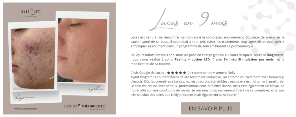 acné boutons soins visage nano boté clermont ferrand 2